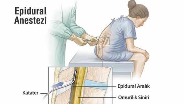 Епідуральна анестезія - що це таке?