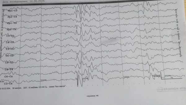 ЕЕГ (Електроенцефалограма) - розшифровка