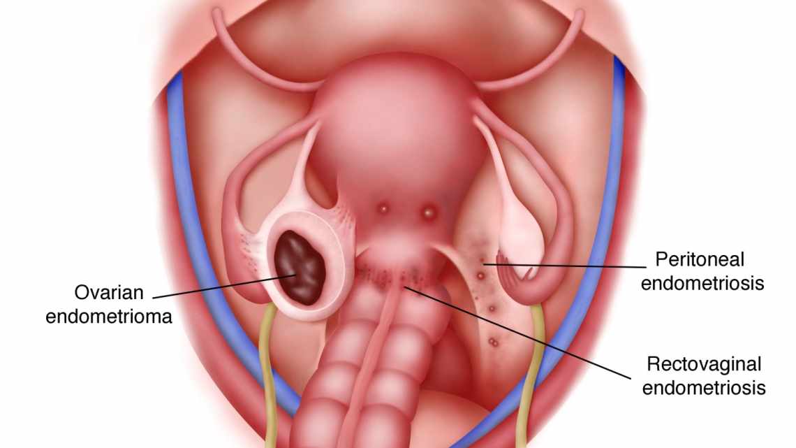 Діагностика ендометріозу
