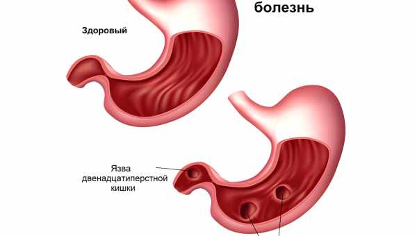 Вживання фесталу при хронічному гастриті