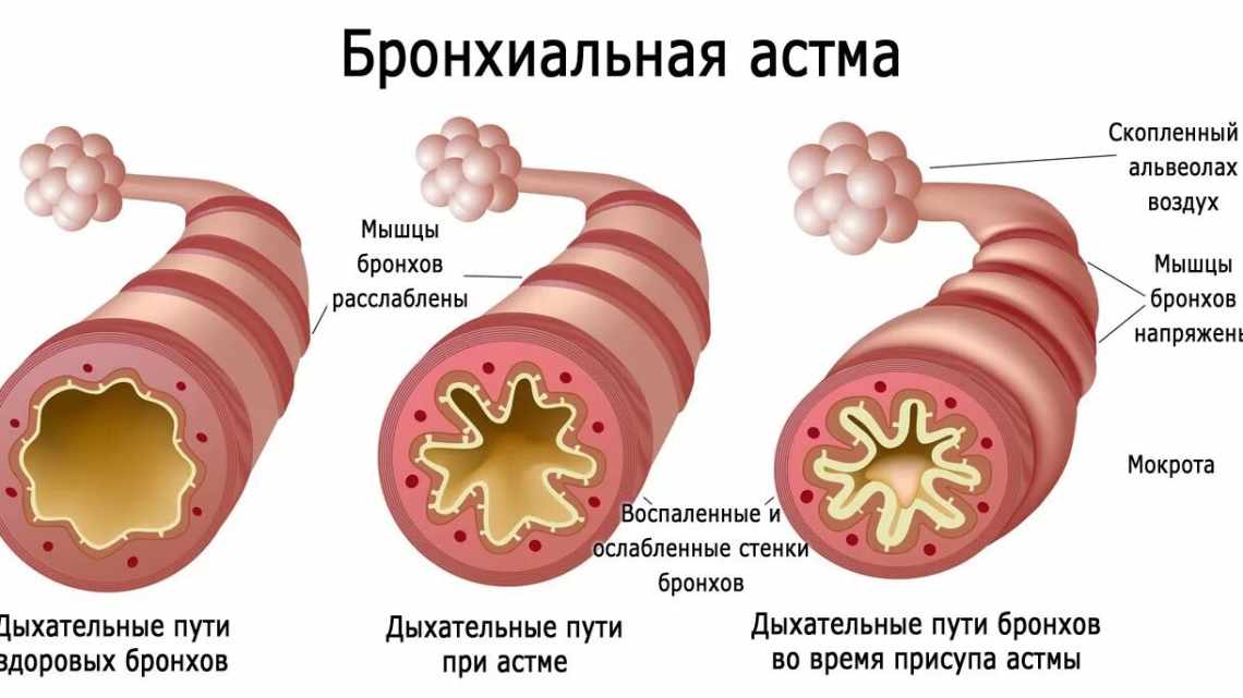 Еуфіллін при лікуванні бронхіальної астми у вагітних