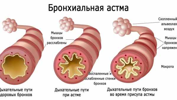 Еуфіллін при лікуванні бронхіальної астми у вагітних