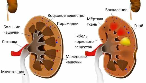 Фітоолізин під час лікування пієлонефриту у дітей