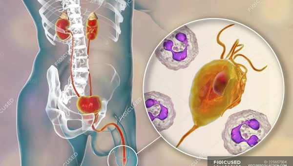 Фуразолідон у лікуванні трихомонозу