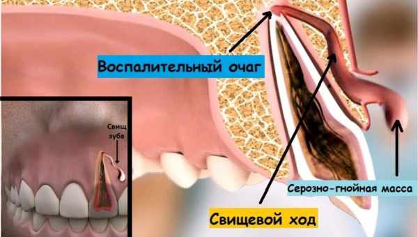 Кіста на корені зуба, як позбутися