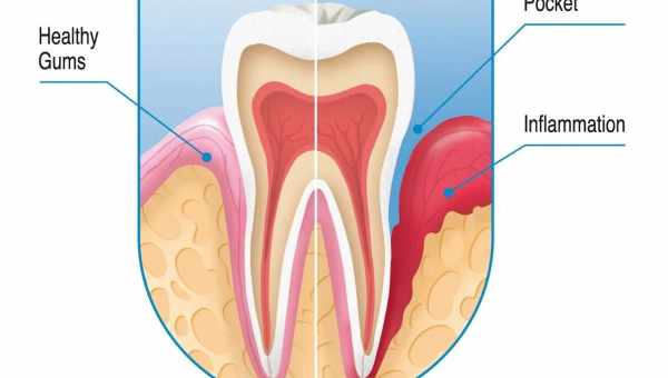 Зуб у десні: що робити