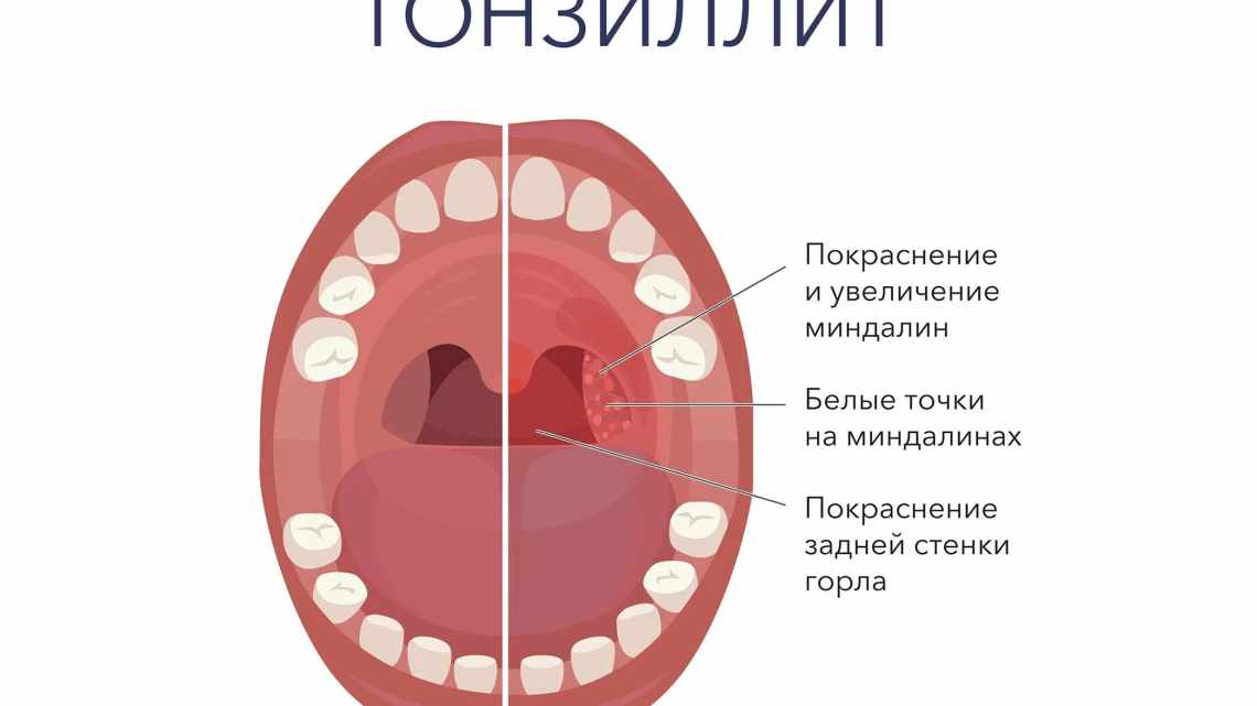 Ангіна при вагітності