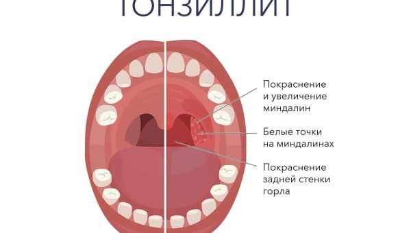 Ангіна при вагітності