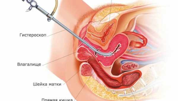 Вагітність після гістероскоп  Гістероскопія - один з методів діагностики та лікування жіночих гінекологічних захворювань. Дозволяє оглянути порожнину матки за допомогою різних оптичних систем.