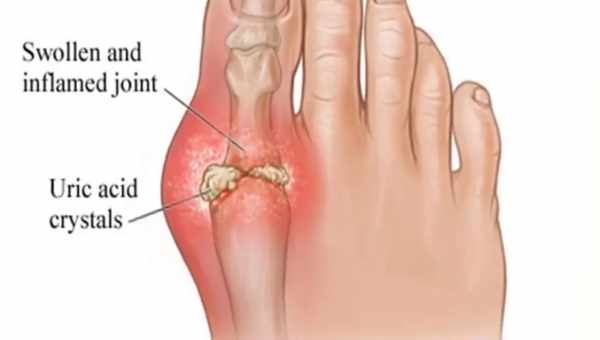 Підагра: народні кошти для виведення надлишку сечової кислоти з організму. Як вилікувати підагру народними засобами?
