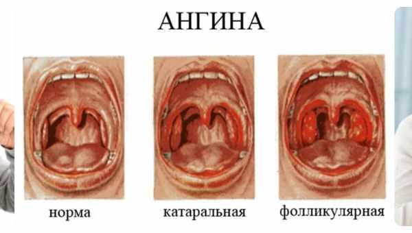 Лікування горла і раку за допомогою гвоздики