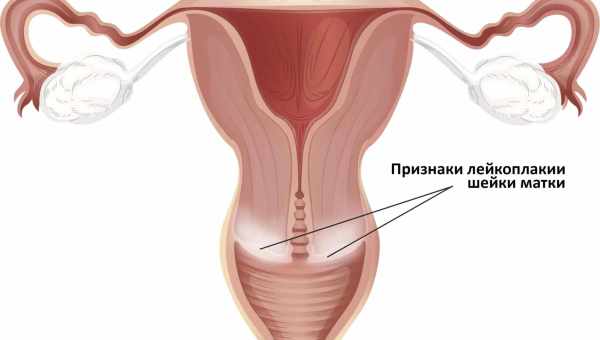 Лікування поліпа шийки матки