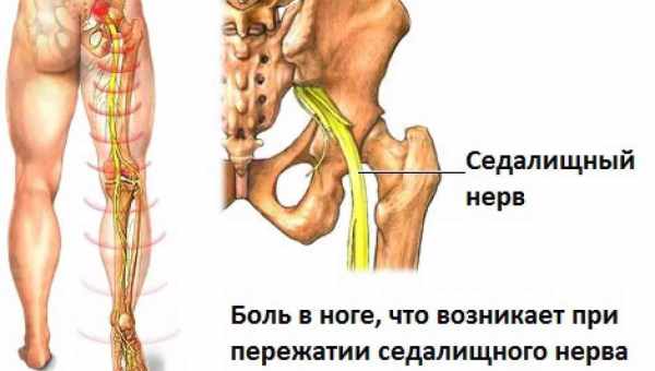 Ішіас і причини його виникнення