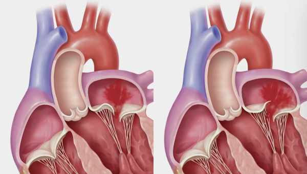 Загальні відомості про пролапс мітрального клапана