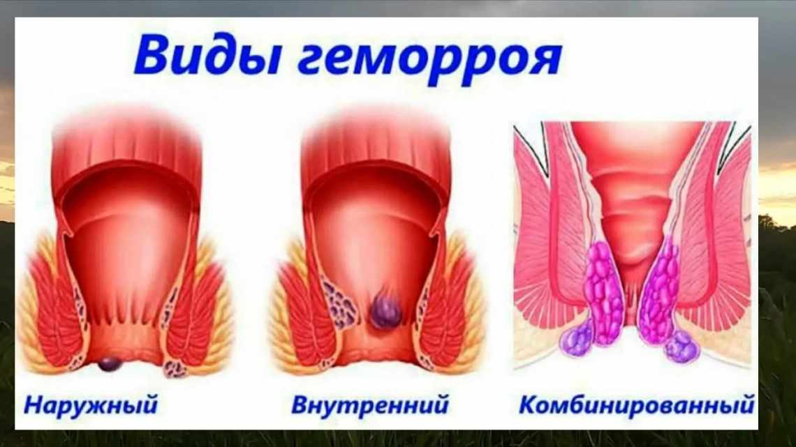 Пролапс анального сфінктера