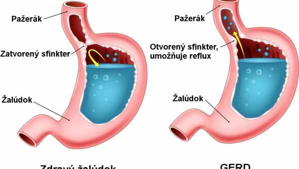 Бульбашково-сечонковий рефлюкс у дітей