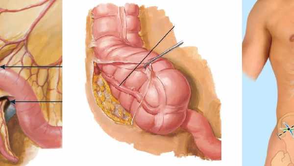 Спайки в кишечнику