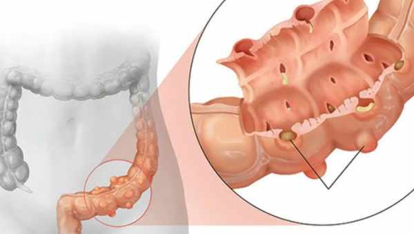 Що робити при запаленні сигмовидної кишки? До якого лікаря звертатися, як лікуватися, якщо почалося запалення сигмовидної кишки