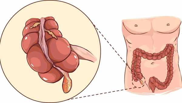 Запалення апендиксу - причини, як уникнути ускладнень. Симптоми та методи лікування запалення апендиксу