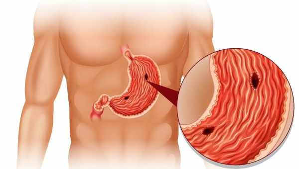 Запалення слизової шлунка (гастрит): причини появи і симптоми. Як лікувати запалення слизової шлунка?