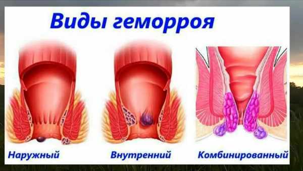 Геморой після пологів: причини, симптоми. Як лікувати геморой після пологів