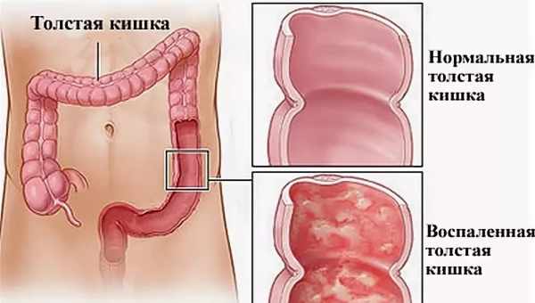 Запалення товстої кишки: причини, симптоми. Методи лікування запалення товстої кишки
