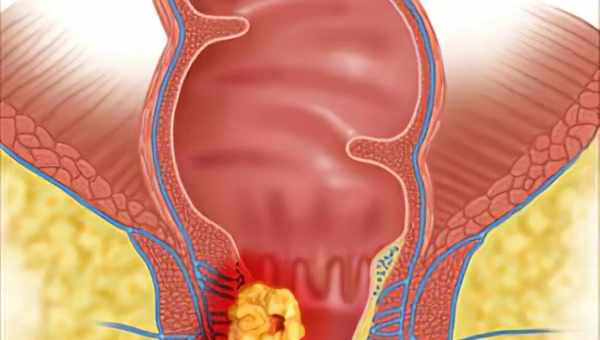 Запалення заднього проходу: причини виникнення. Запалення заднього проходу - симптоми та ефективне лікування