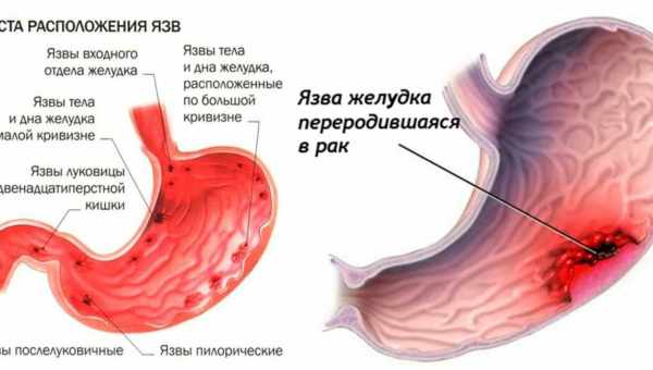 Виразка шлунка: 8 ранніх симптомів, з якими потрібно швидше звертатися до лікаря